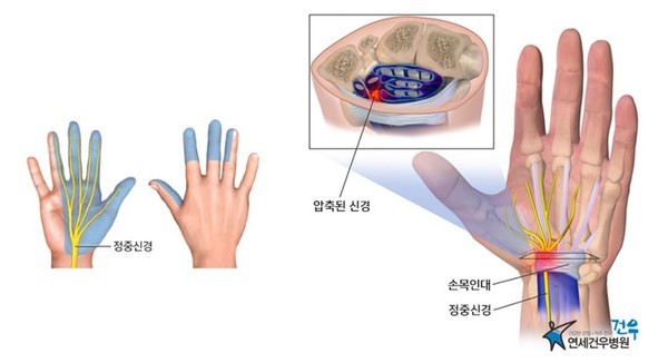 손목터널증후근 신경
