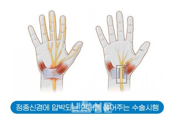 손목터널증후근 수술법2